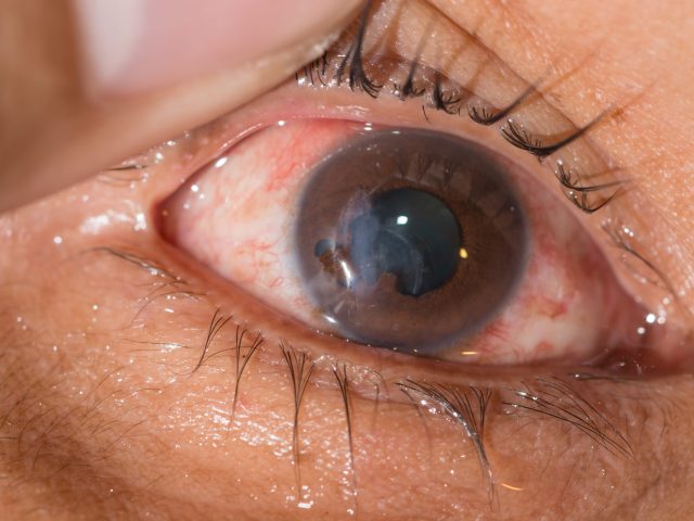 Glaucoma: Early Signs, Risk Factors, and Why Regular Screening Matters