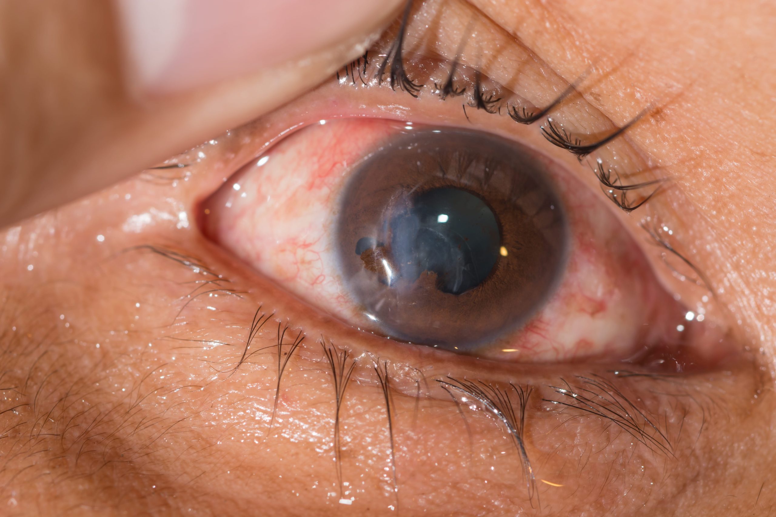 Close-up of an eye with visible corneal clouding and redness, illustrating glaucoma signs and symptoms