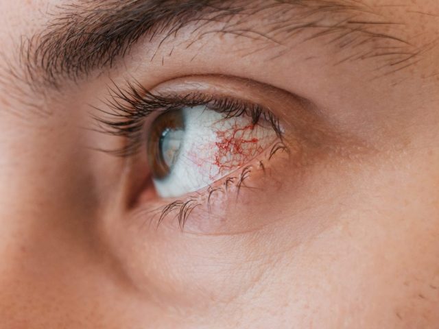 Laser Treatment for Retinal Tear: What Patients Should Know
