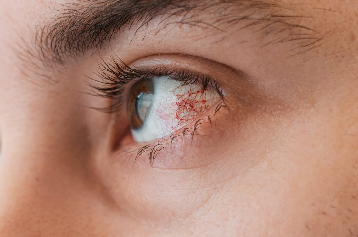 Close-up image of a human eye showing a retinal tear and visible blood vessels, highlighting the need for laser treatment for retinal tear to prevent further retinal damage and vision loss.